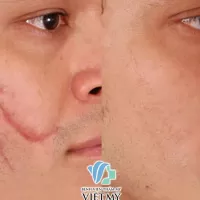 Điều trị mụn, sẹo xấu, rạn da bằng laser